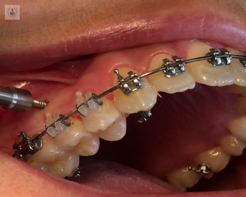 Microtornillos en ortodoncia 