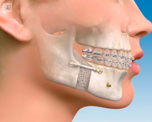 toxina-botulinica-y-acido-hialuronico-en-cirugia-maxilofacial imagen de artículo