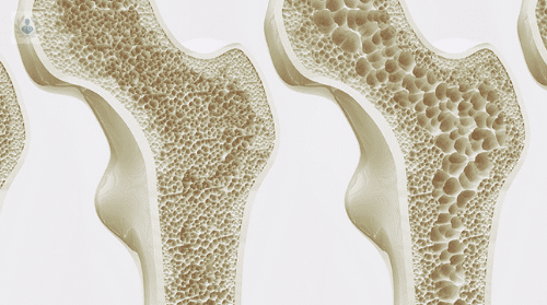 Osteoporosis de Tipo I y Osteoporosis secundaria