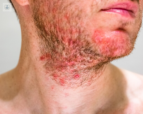 la-dermatitis-seborreica-causas-y-tratamiento imagen de artículo