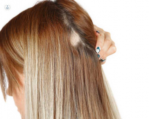 alopecia-tipos-y-tratamiento imagen de artículo