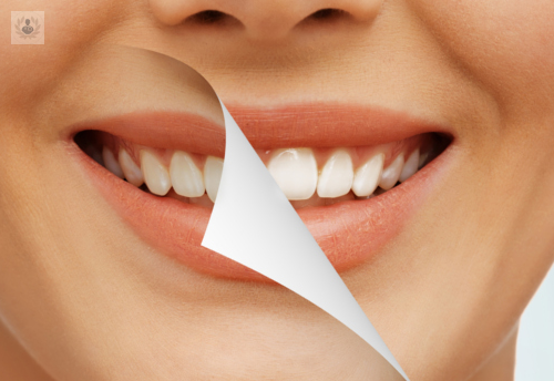 el-blanqueamiento-dental imagen de artículo