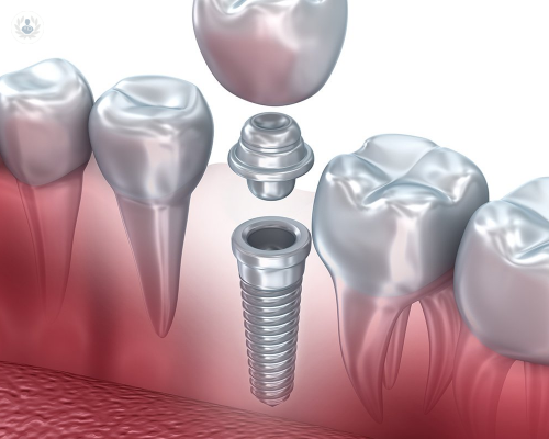 La carga inmediata en Implantes Dentales