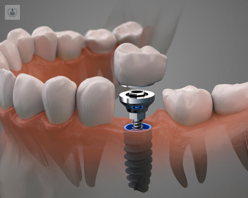 la-efectividad-de-los-implantes-dentales imagen de artículo