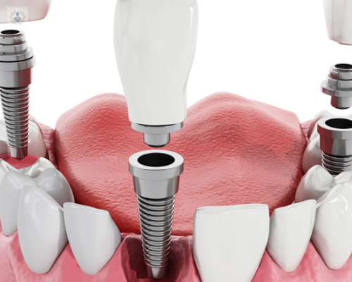 conozca-los-implantes-dentales imagen de artículo