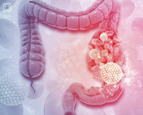 cancer-de-colon imagen de artículo