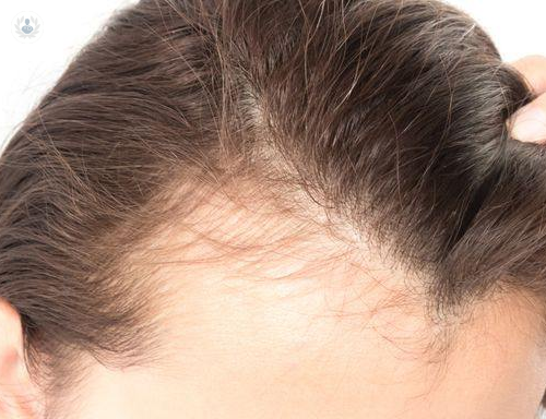 Alopecia Femenina