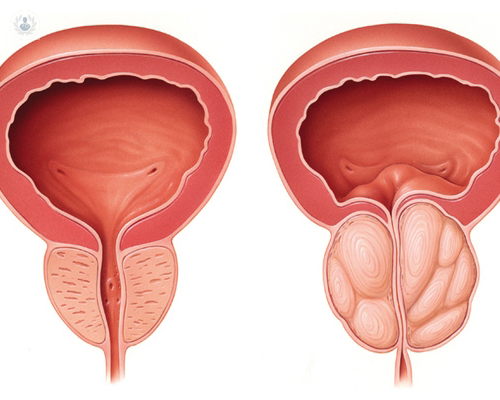 tratamiento-quirurgico-de-la-hipertrofia-prostatica-benigna imagen de artículo