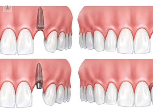 implantes-dentales-oseointegrados imagen de artículo