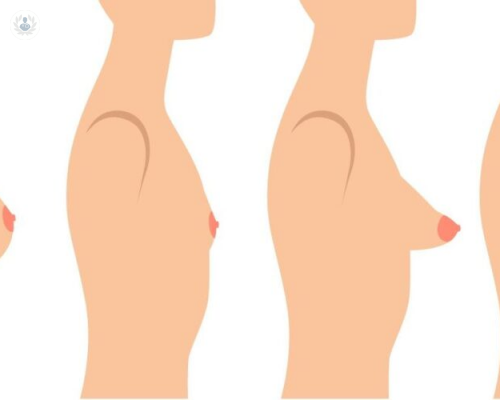 las-mamas-tuberosas imagen de artículo
