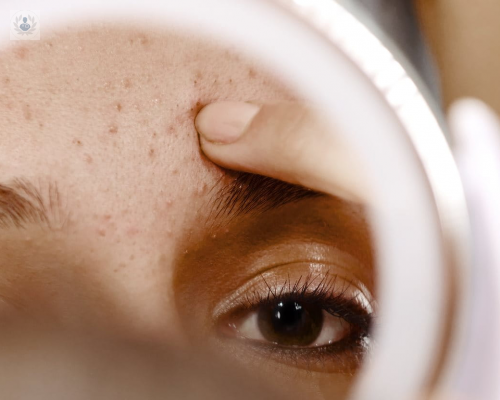 el-acne-no-es-un-enemigo-pequeno imagen de artículo