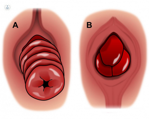prolapso-rectal imagen de artículo