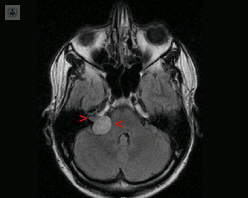 Cirugía del Neurinoma del Acústico