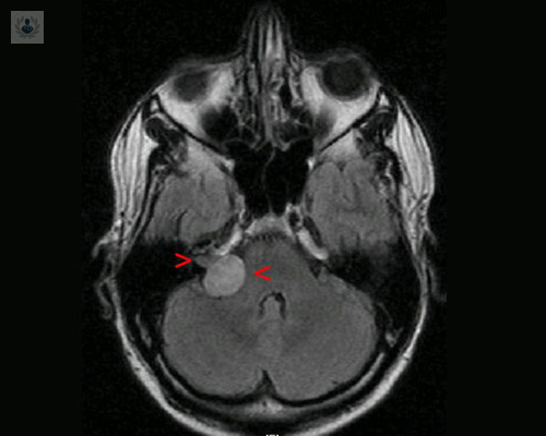 cirugia-del-neurinoma-del-acustico imagen de artículo