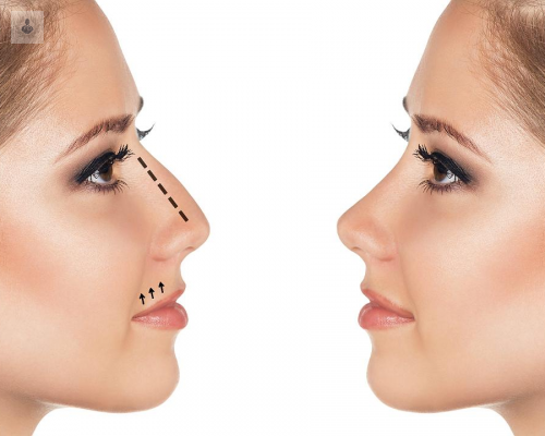 rinoplastia-consigue-la-nariz-deseada imagen de artículo