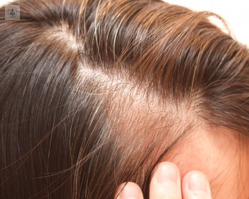 alopecia-androgenetica-femenina imagen de artículo