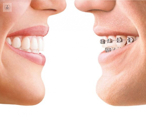 invisalign-una-alternativa-estetica-fiable-a-los-brackets imagen de artículo