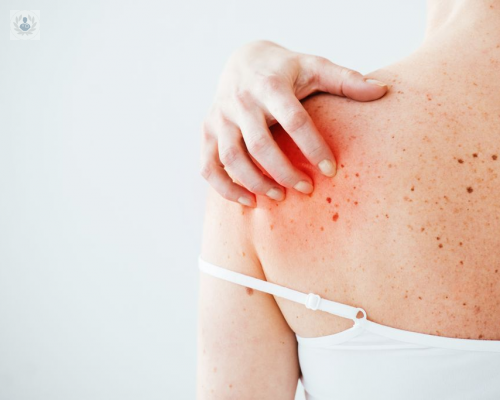 melanoma-maligno-un-tumor-cada-vez-mas-frecuente imagen de artículo