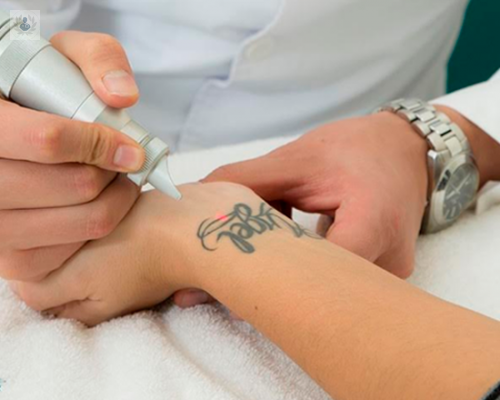 eliminar-tatuajes-con-laser imagen de artículo