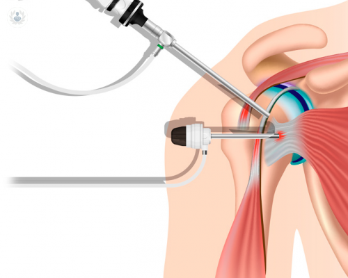 artroscopia-de-hombro imagen de artículo