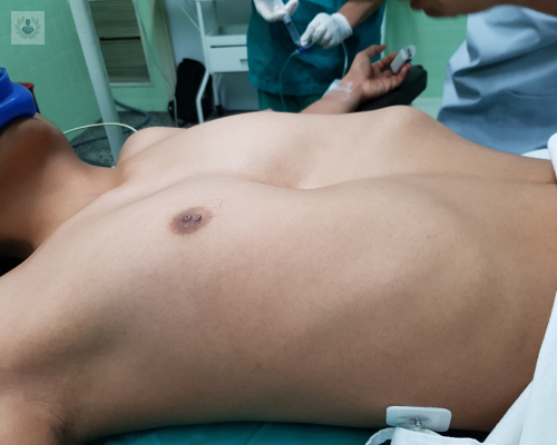 pectus-excavatum imagen de artículo