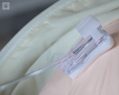 port-a-cath-comodidad-al-servicio-del-paciente imagen de artículo