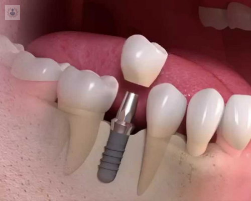 implantologia-dental imagen de artículo