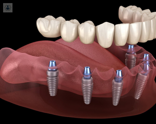 implantes-para-toda-la-vida imagen de artículo