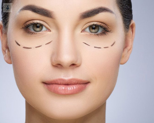 blefaroplastia-rejuvenece-tu-mirada imagen de artículo