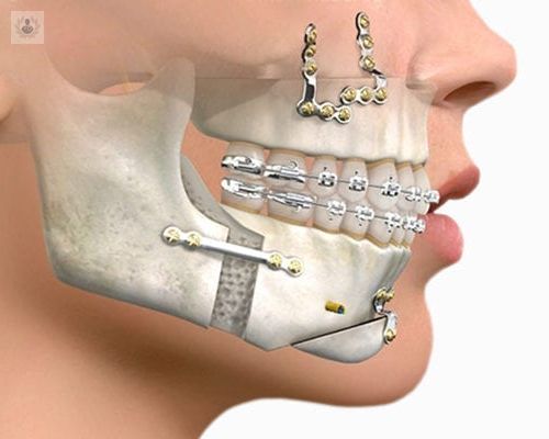 cirugia-ortognatica-una-combinacion-de-ortodoncia-y-cirugia-maxilofacial imagen de artículo