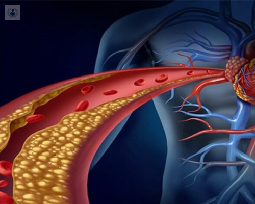 causas-y-tratamiento-de-la-arterioesclerosis imagen de artículo