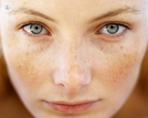 tratamiento-con-laser-de-las-lesiones-pigmentadas imagen de artículo