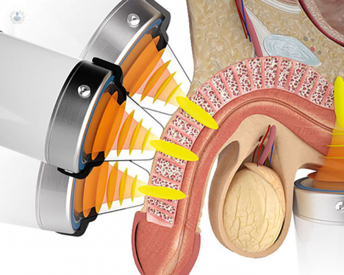 ondas-de-choque imagen de artículo