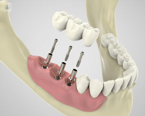 implantes-de-carga-inmediata-una-intervencion-nada-dolorosa imagen de artículo