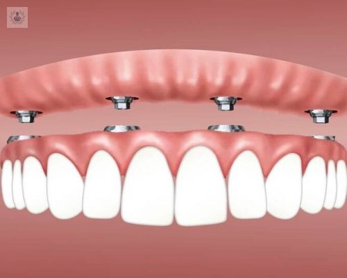 avances-en-implantes-dentales imagen de artículo