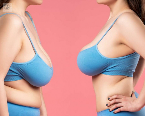 elevacion-de-pecho imagen de artículo