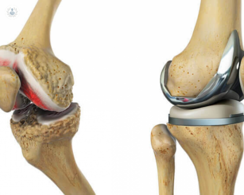 la-protesis-de-rodilla imagen de artículo