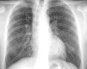 preguntas-frecuentes-sobre-la-bronquitis-cronica imagen de artículo