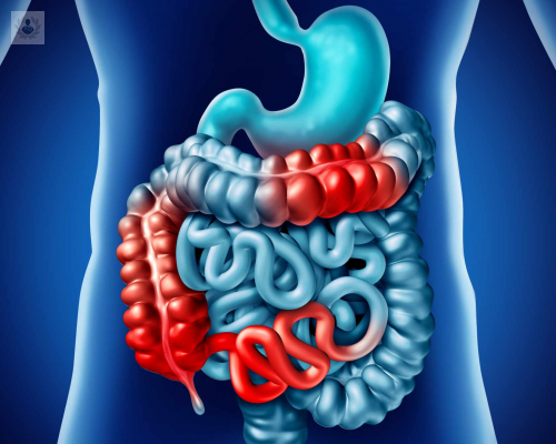 la-enfermedad-de-crohn imagen de artículo