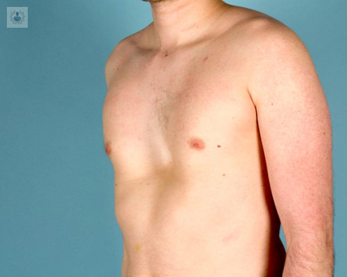 pectus-excavatum-causas-sintomas-y-tratamiento imagen de artículo