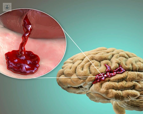 Hemorragia Cerebral: causas y síntomas