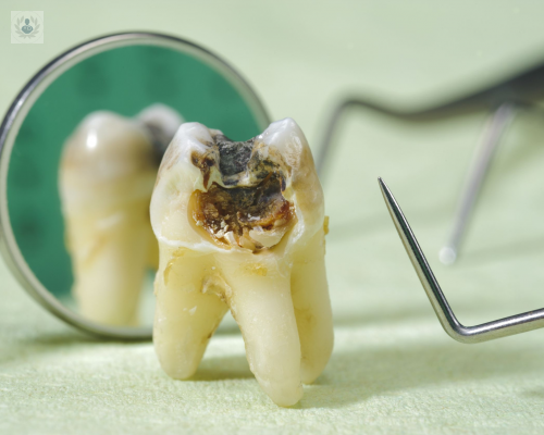 preguntas-habituales-sobre-endodoncia imagen de artículo