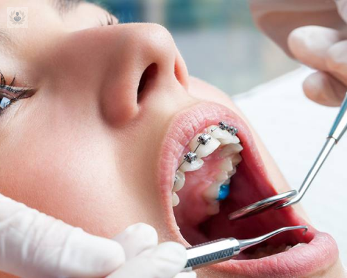 La nueva Ortodoncia Dental: en busca de la sonrisa perfecta de forma rápida y personalizada