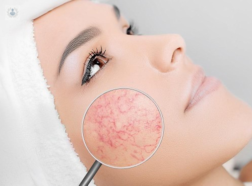 tratamiento-de-la-cuperosis-y-las-aranas-vasculares imagen de artículo