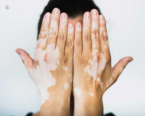 el-vitiligo imagen de artículo