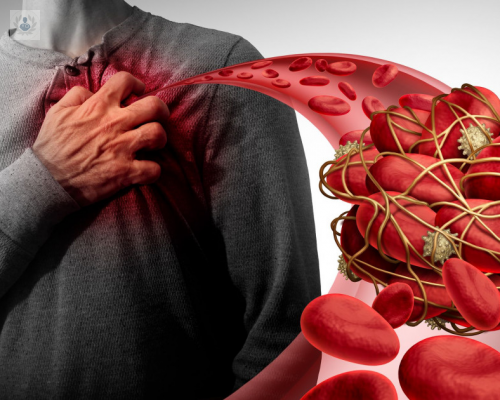 la-embolia-y-su-prevencion imagen de artículo