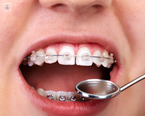 maloclusion-dental-infantil imagen de artículo