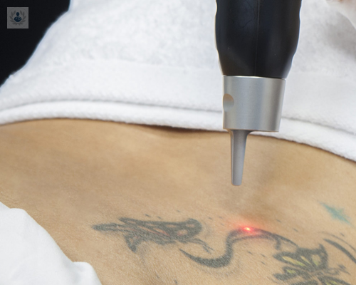 avances-en-laser-para-eliminar-tatuajes imagen de artículo