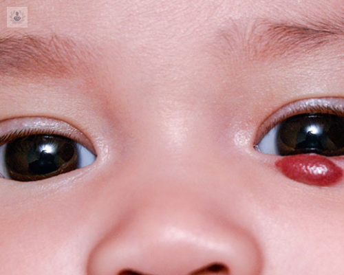 hemangiomas-manchas-de-nacimiento imagen de artículo