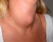 bocio-causas-sintomas-y-tratamiento imagen de artículo